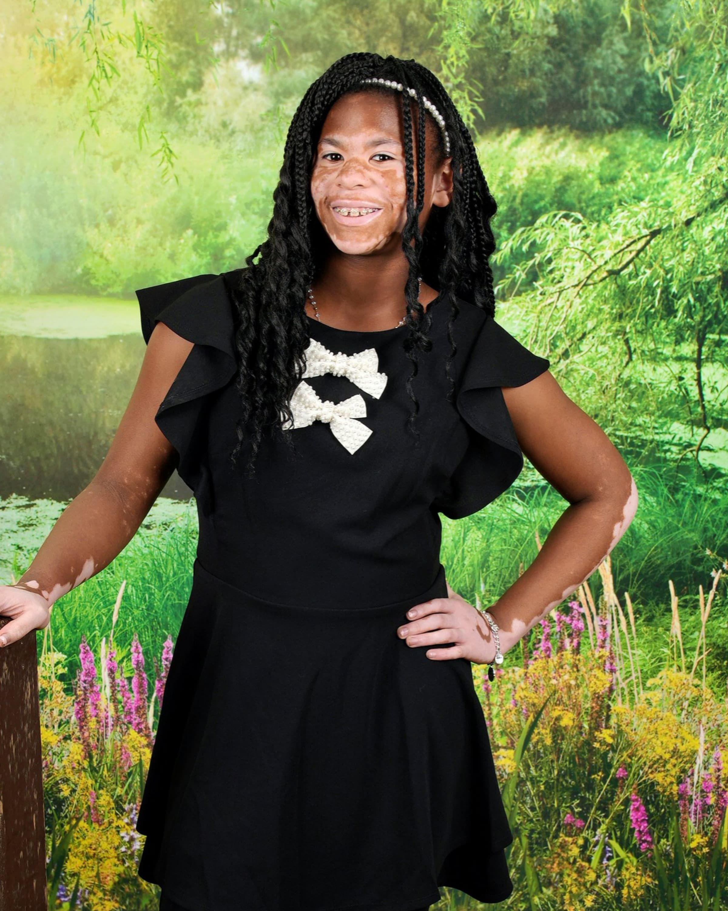 Smiling girl with vitiligo and long braids posing in a black dress with white bows.